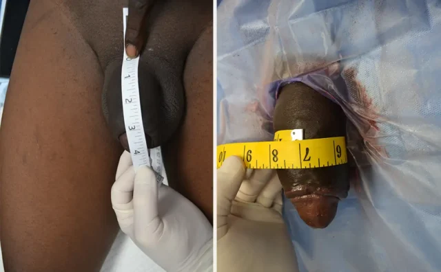Before & After Male Enlargement Clinic