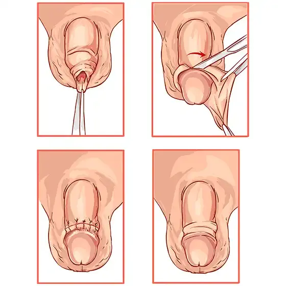 circumcision-tampa https://staging.enhancedmedical.com/wp-content/uploads/circumcision-tampa.webp