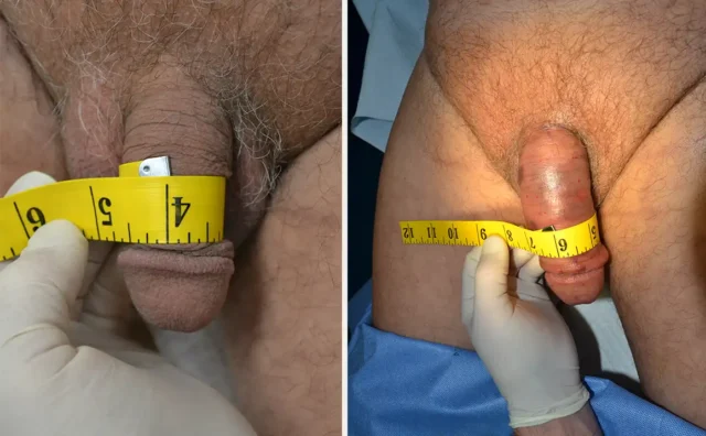 Penile enhancement patient Tampa FL
