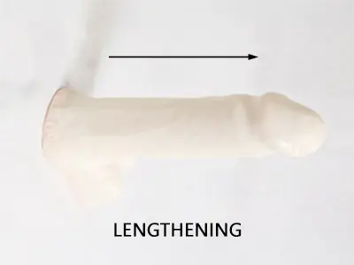 penile-lengthening-surgery-sarasota-fl Penile Lengthening Surgery Sarasota FL