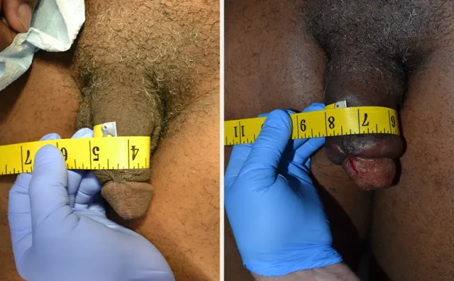 penis-enlargement-patient