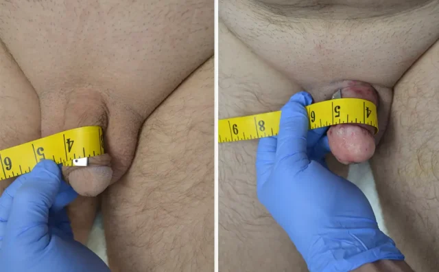 Penis girth patient Tampa