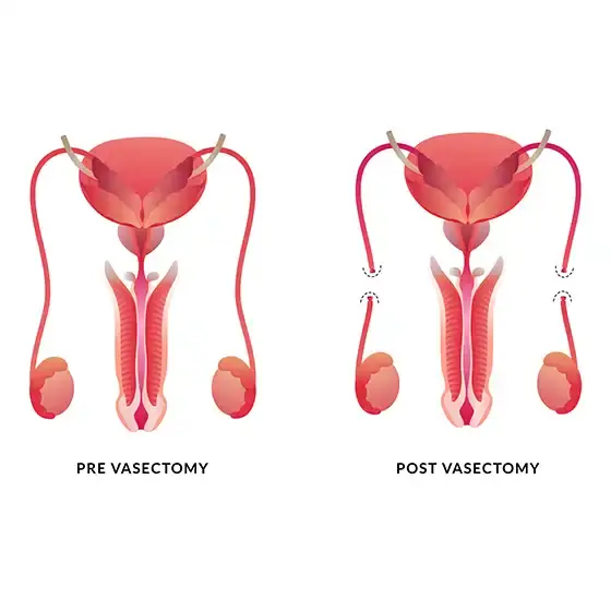vasectomy-tampa https://staging.enhancedmedical.com/wp-content/uploads/vasectomy-tampa.webp